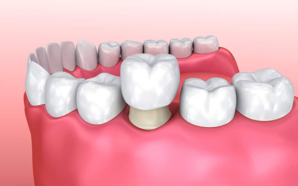 dental crowns 1080x675 1