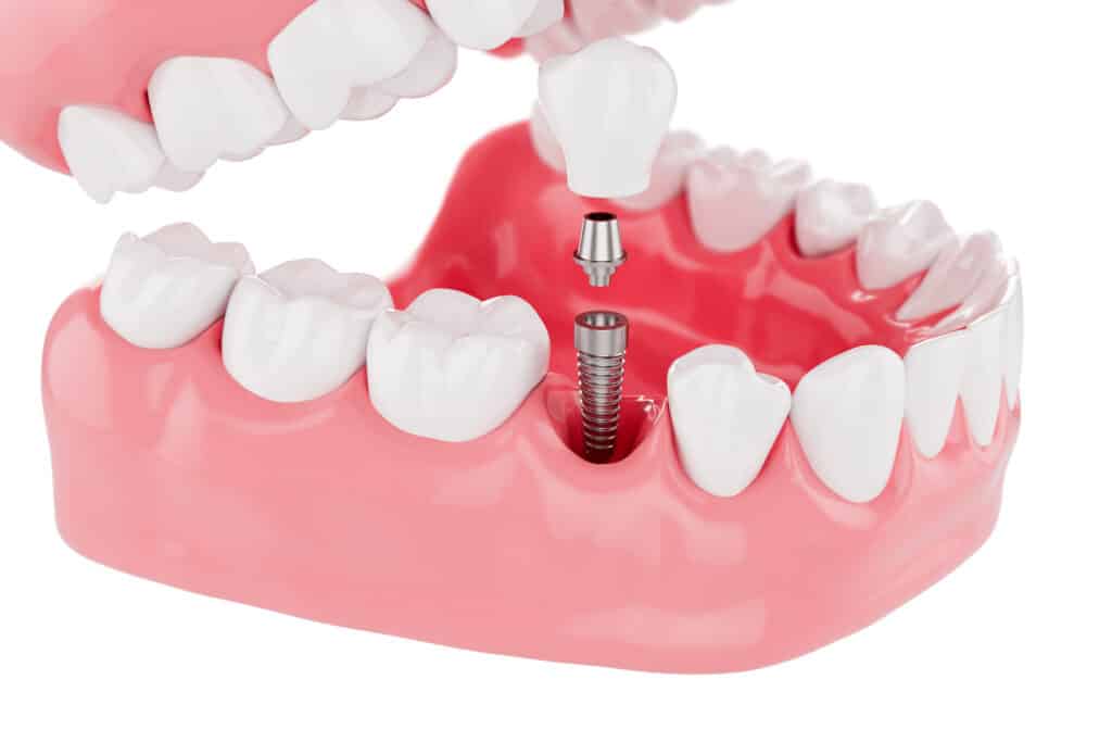 proceso cerca implantes dientes cuidado salud enfoque selectivo renderizado 3d